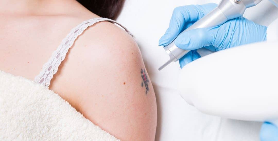 Cosmetic Tattoo Removal