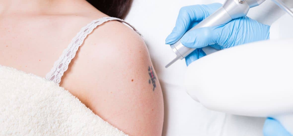 cosmetic tattoo removal