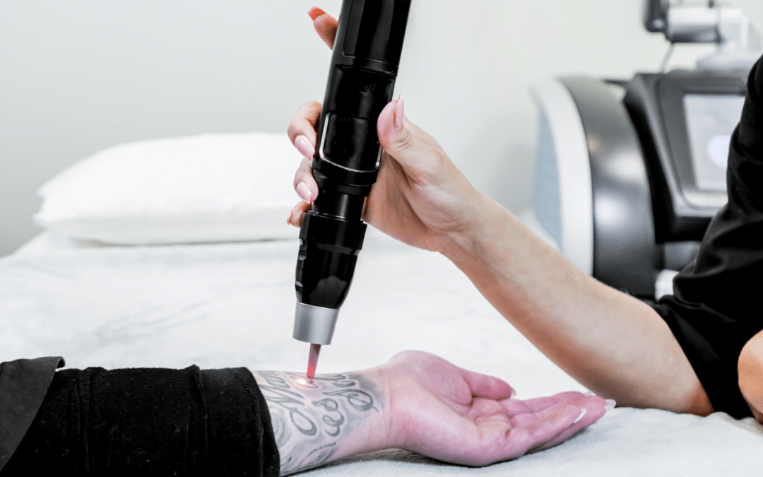 Best Laser Machine For Tattoo Removal