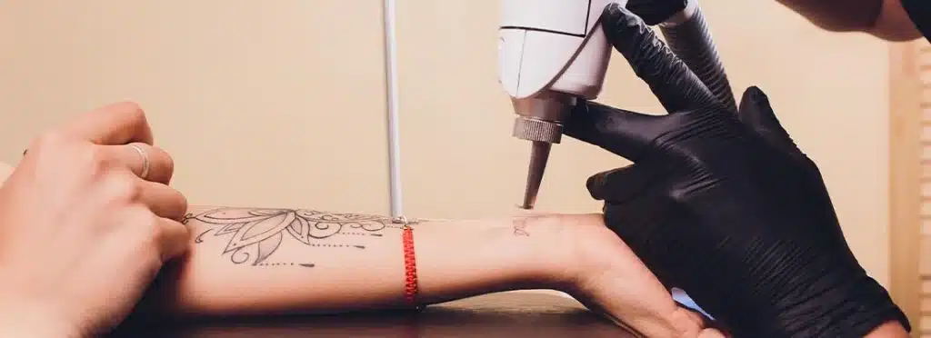 Dark Black Tattoo Removal