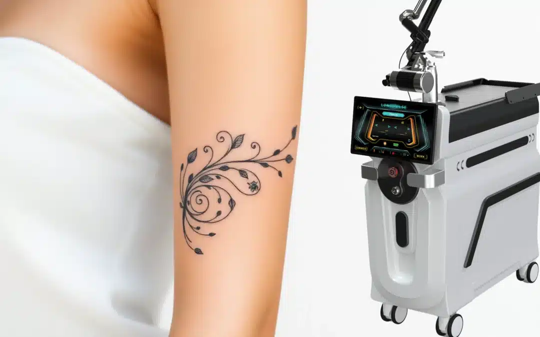 New Laser Tattoo Removal Technology