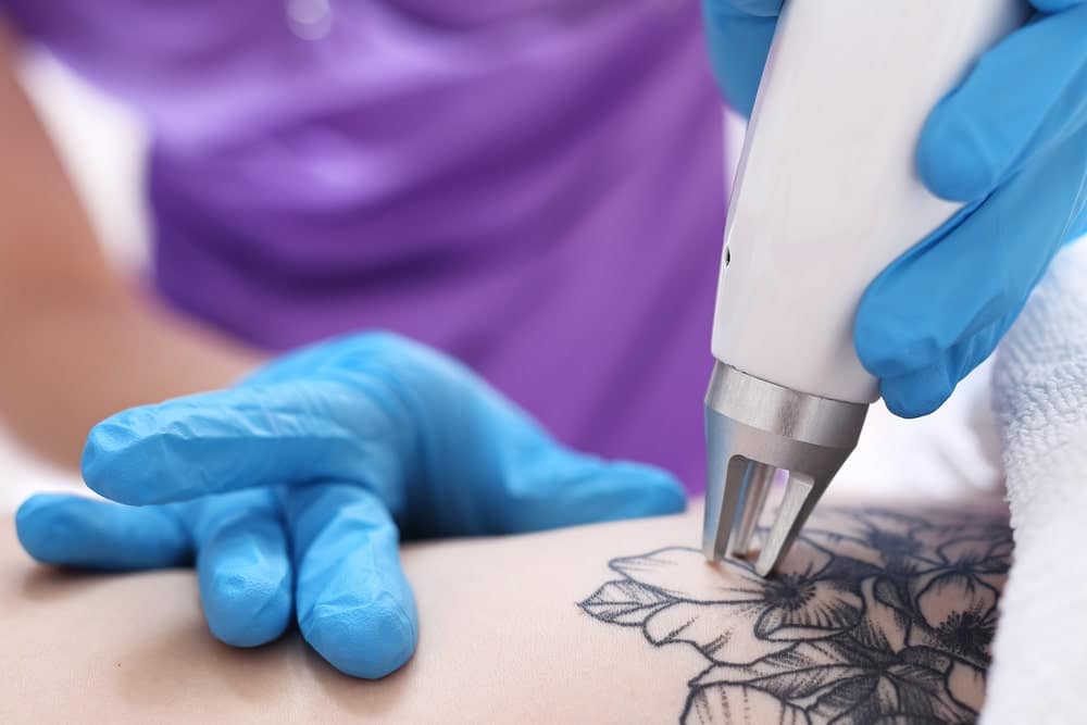 Latest Tattoo Removal Technology