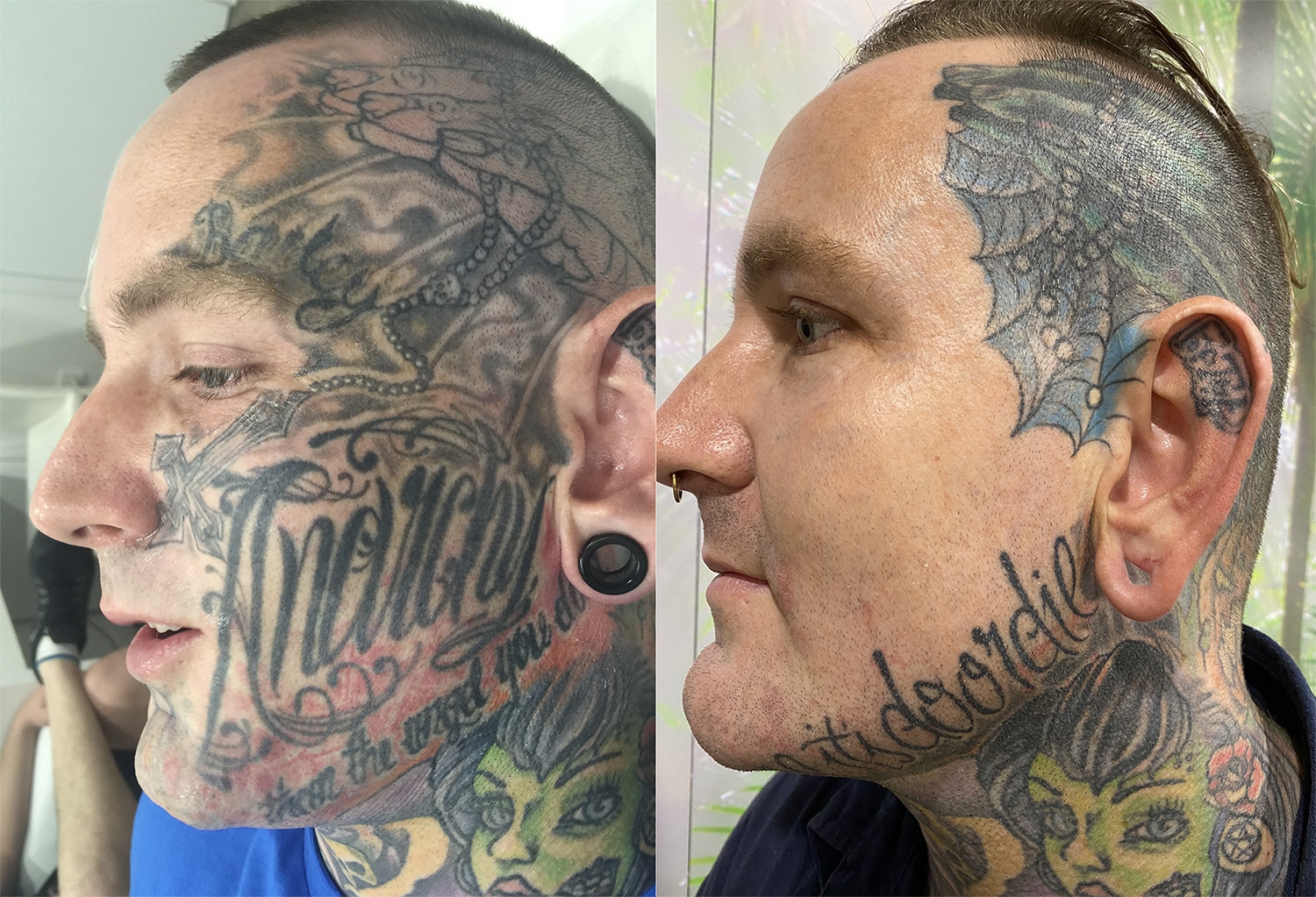 Tattoo Removal Transformation