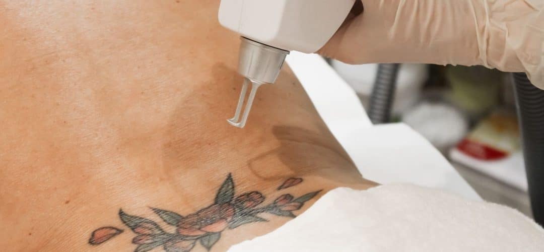 Quanta Tattoo Removal in Winter Park – Safe & Permanent Results