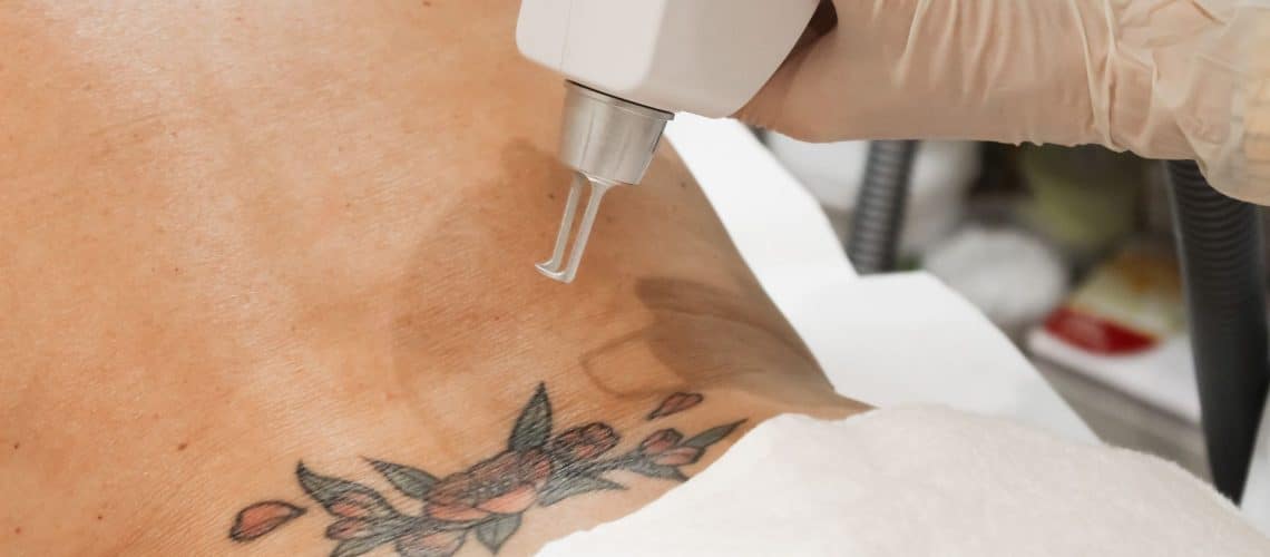 Quanta Tattoo Removal