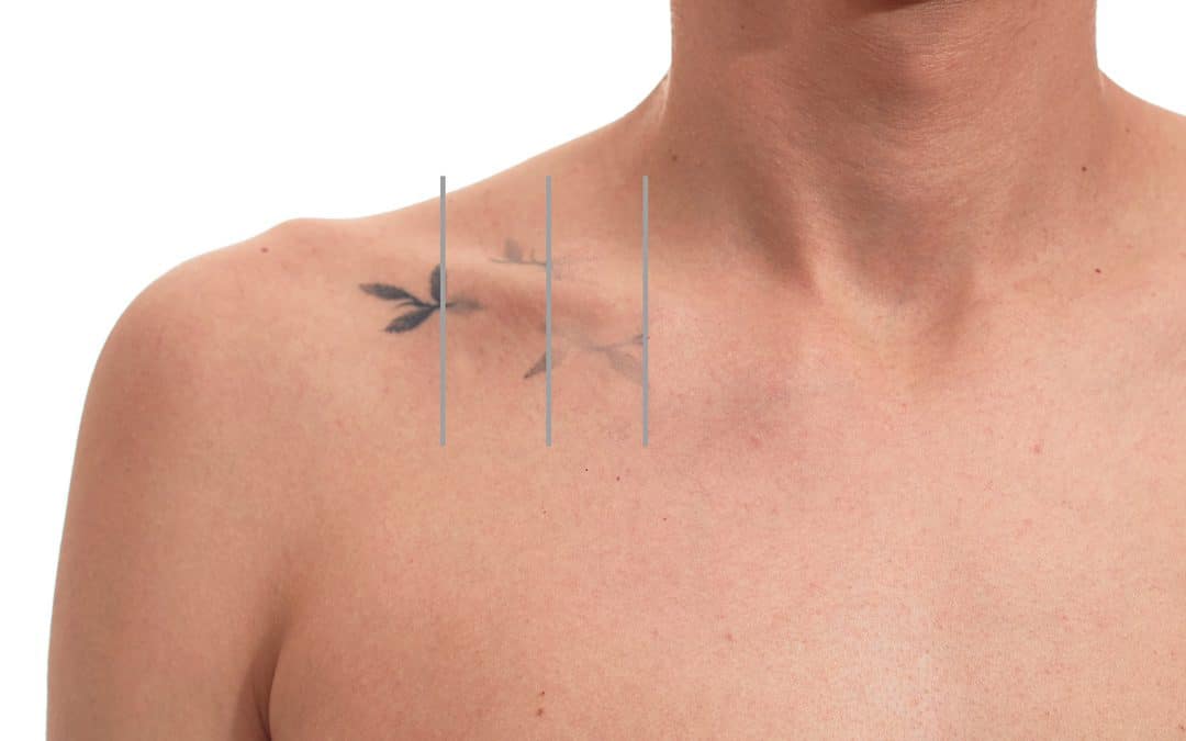 Tattoo Removal Near Me