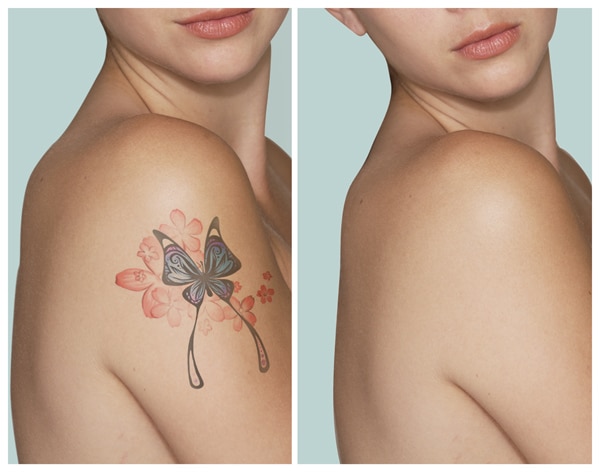 laser tattoo removal vs cream