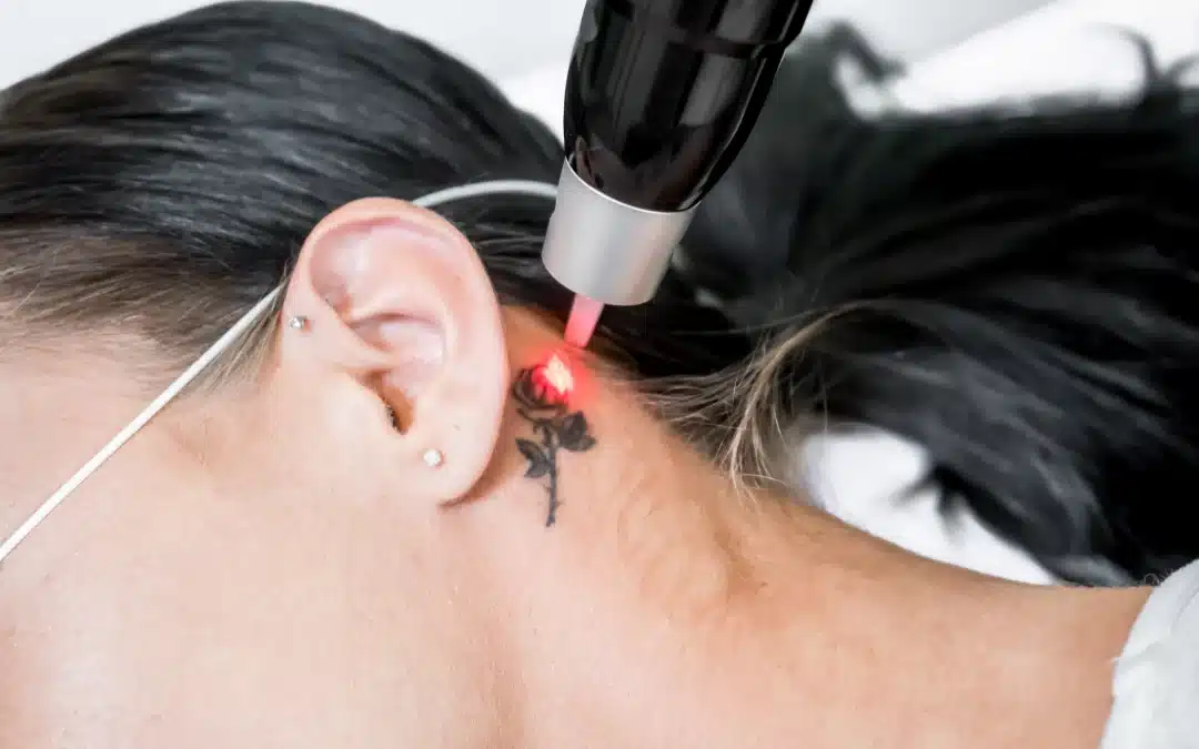 How Much Does Tattoo Removal Hurt? The Truth You Need to Know
