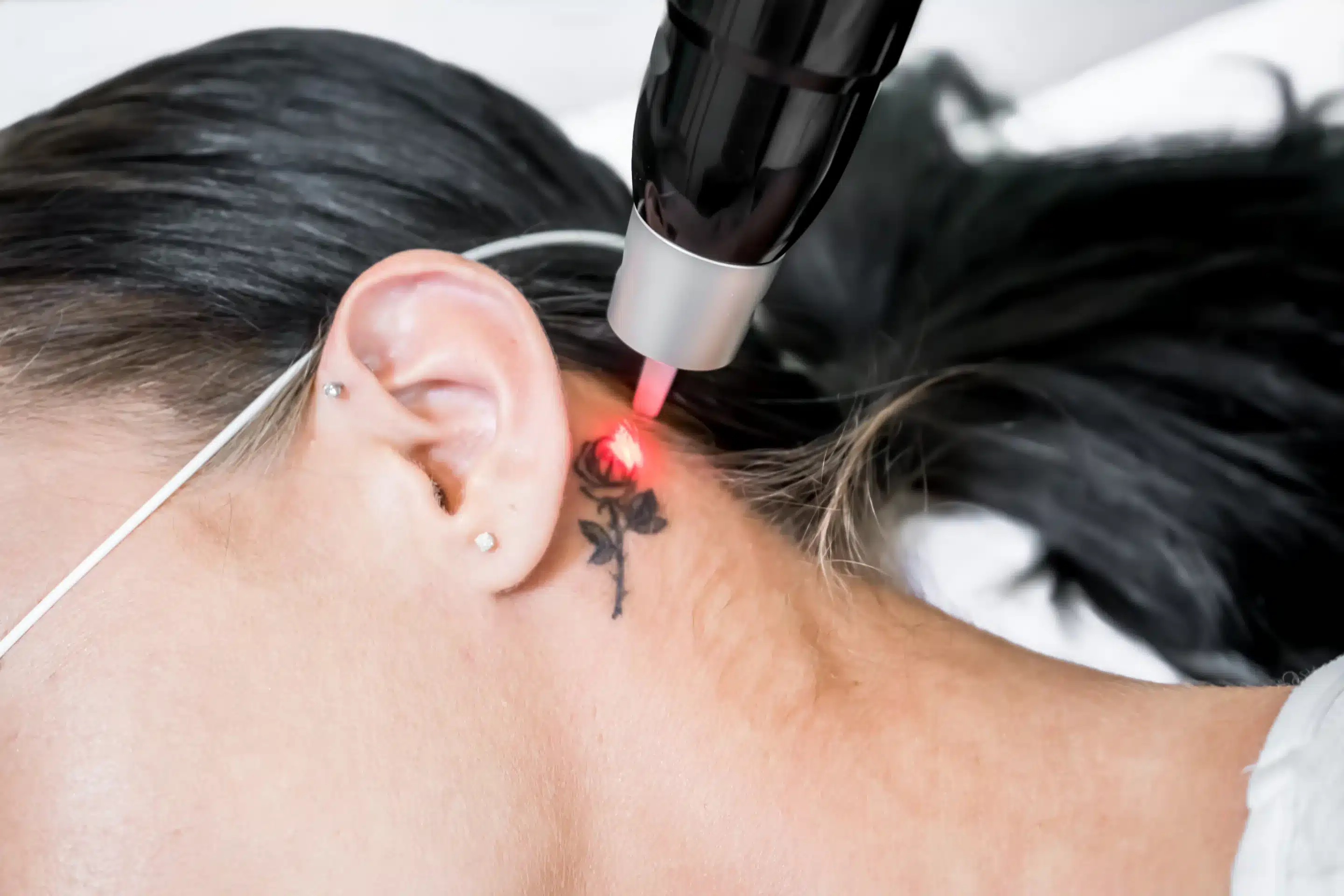 How Much Does Tattoo Removal Hurt?