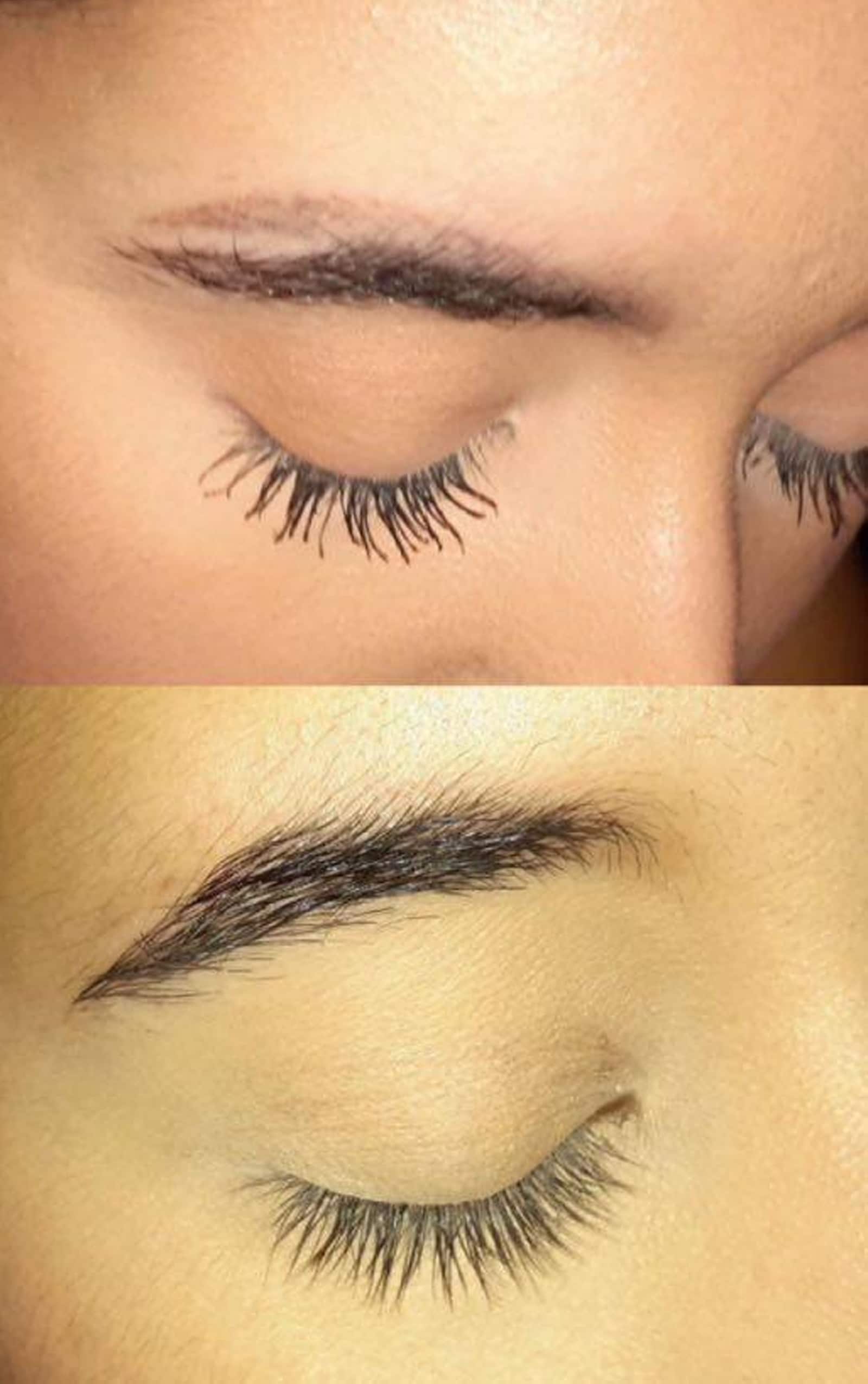 Scar Laser Treatment