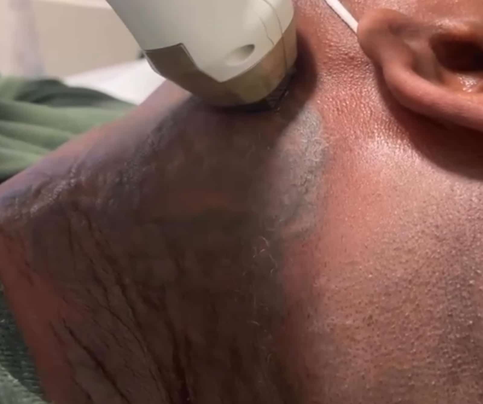 benefit from Scars Removal