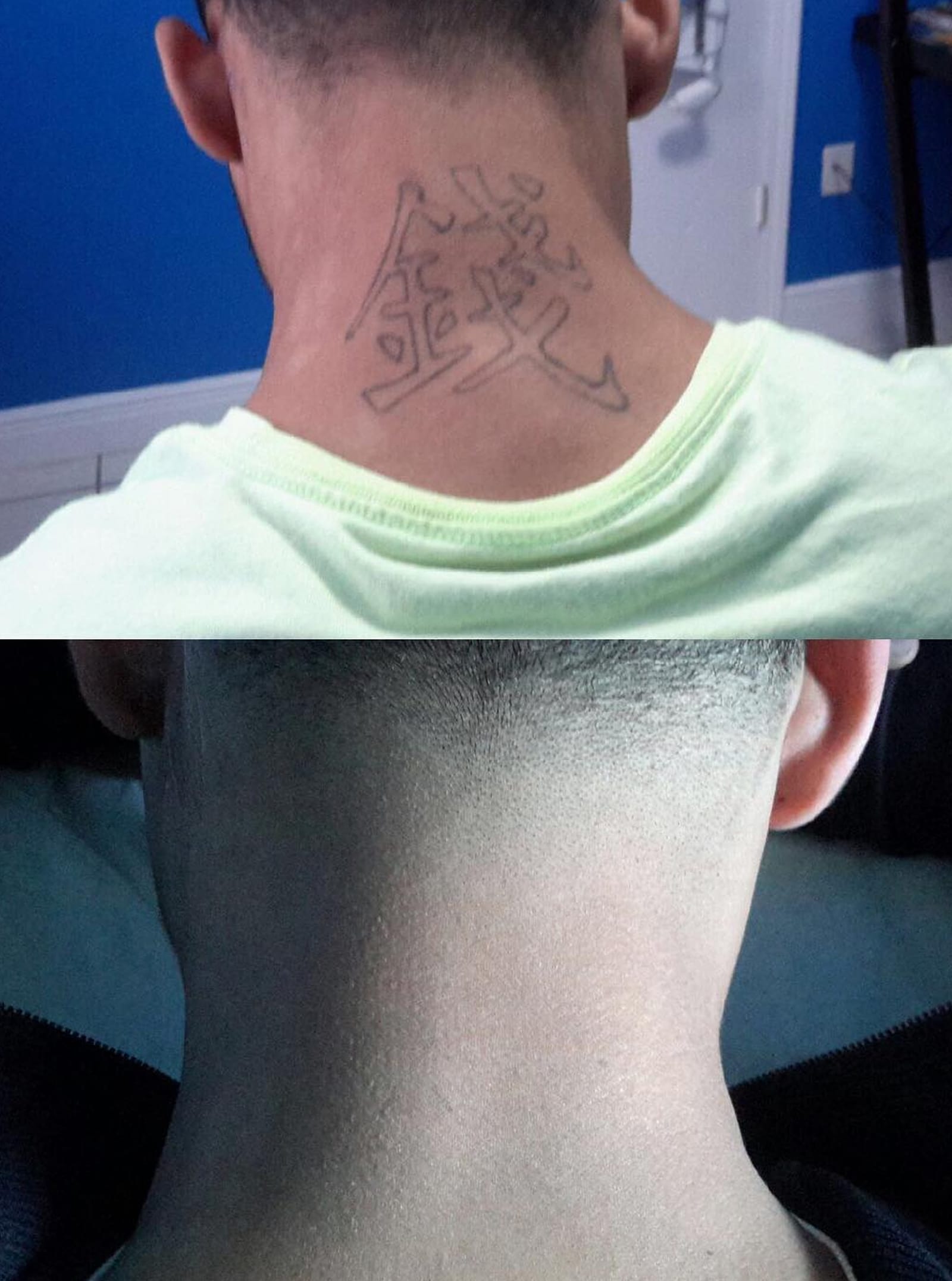 Winter Park Tattoo Removal