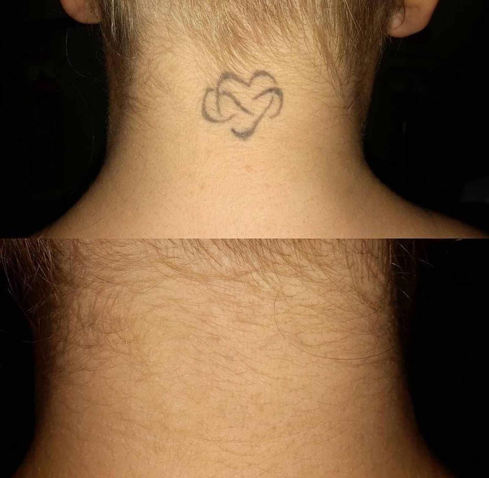 Laser Treatment