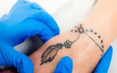 Describe Patch Tattoo Removal