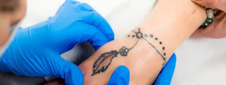 Describe Patch Tattoo Removal