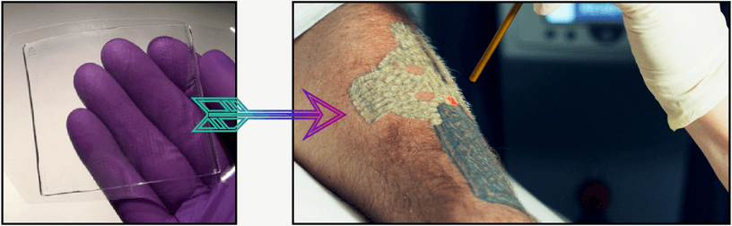 Describe Patch Tattoo Removal