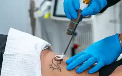 Effective Tattoo Removal with PFD Patch