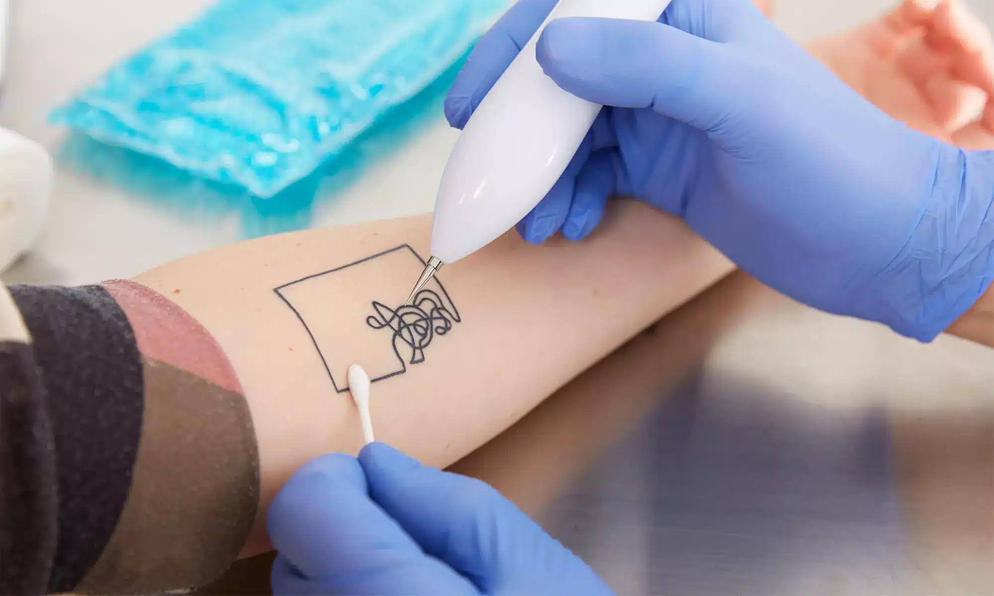 Effective Tattoo Removal with PFD Patch