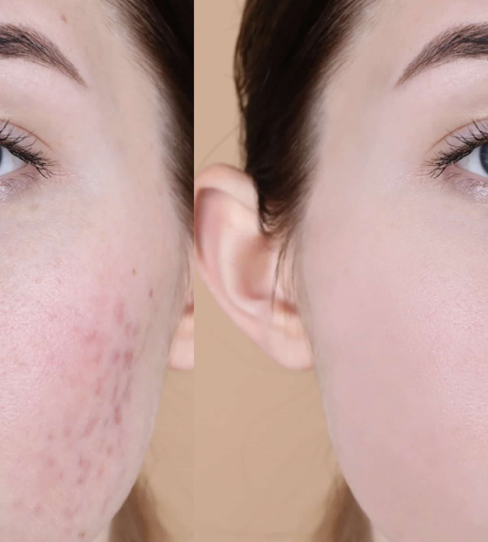 Laser Scar Treatment