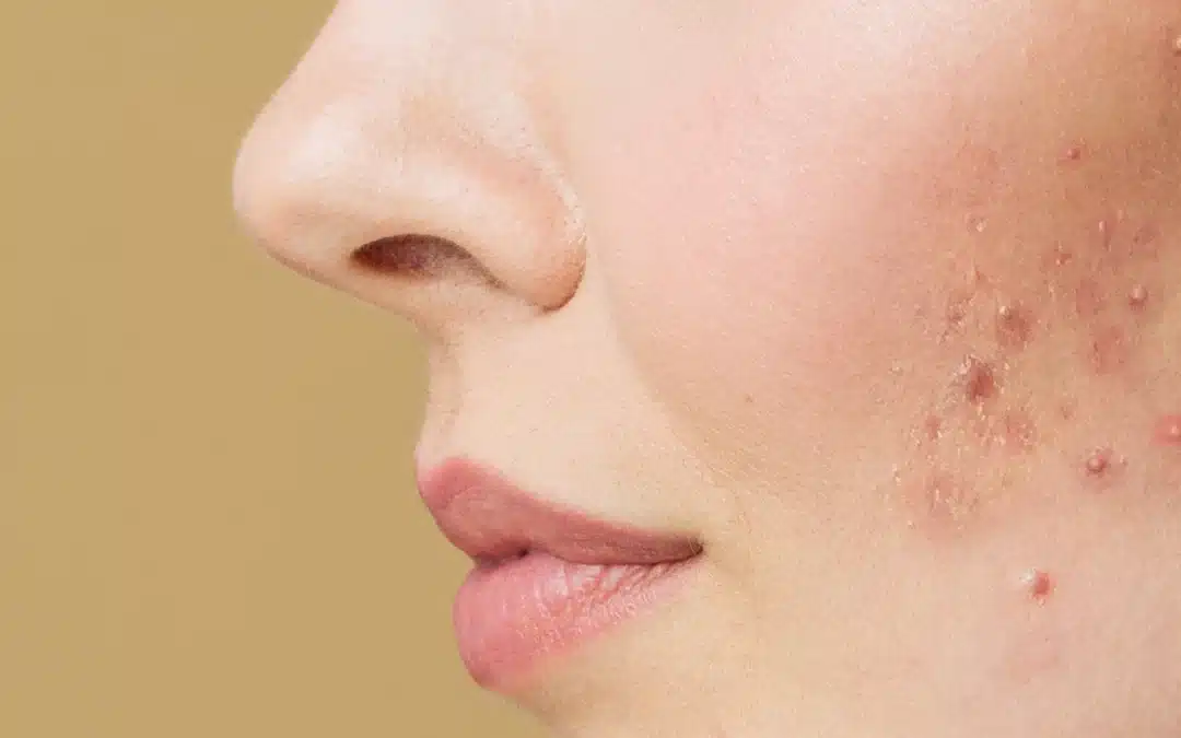 Laser Treatment For Pimple Scars