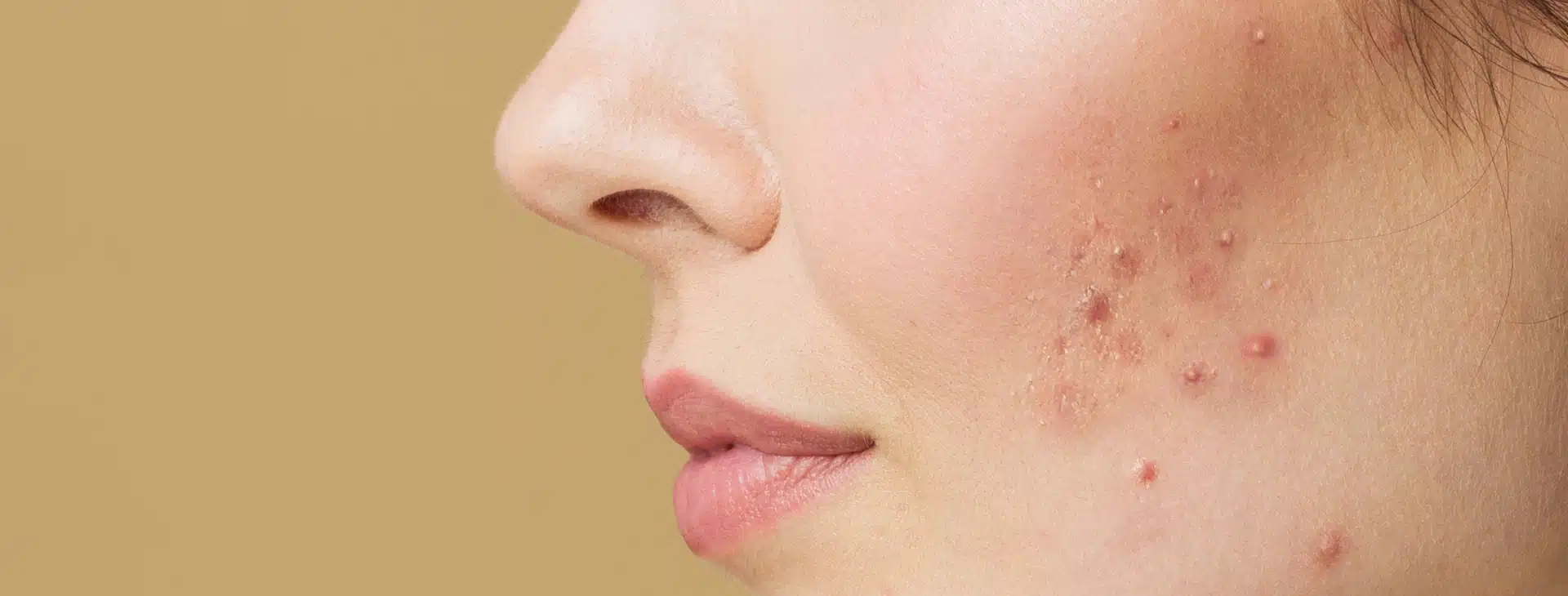 Laser Treatment For Pimple Scars