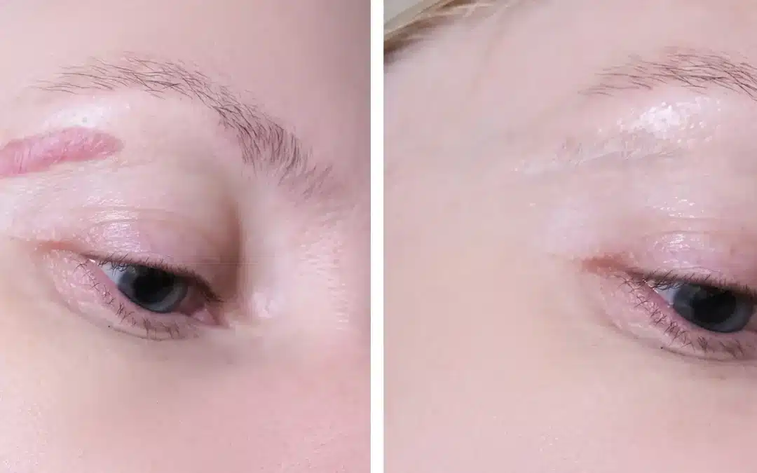 Laser Treatment For Keloid Scars