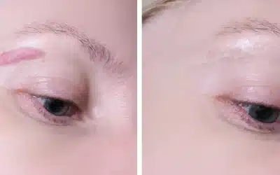 Laser Treatment For Keloid Scars