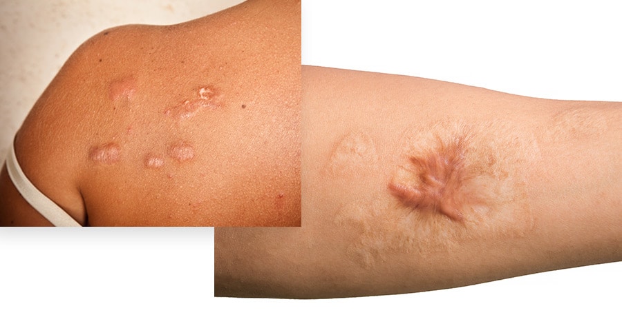 Laser Treatment for Keloid Scars