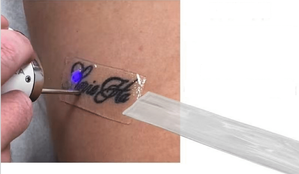 PFD Patch Tattoo Removal Results
