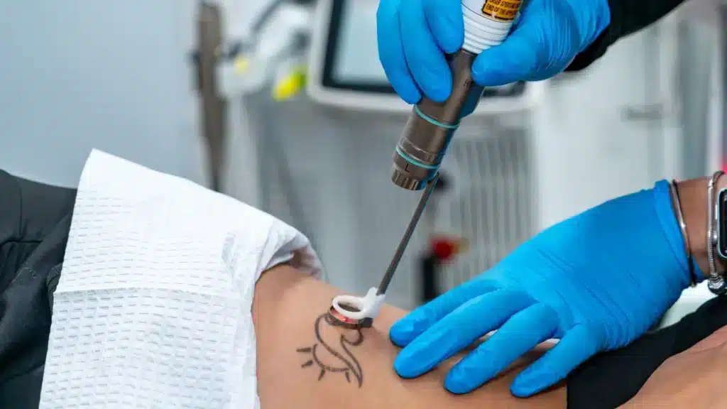 PFD Patch Tattoo Removal Results