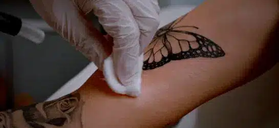 PFD Patch Tattoo Removal in Winter Park