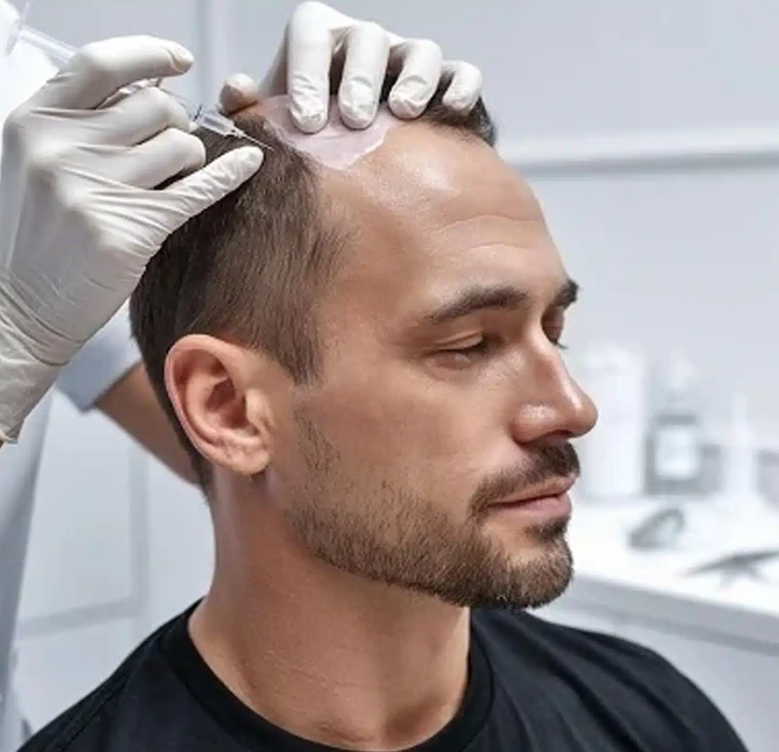 Scalp Micropigmentation Last Scalp Micropigmentation Last