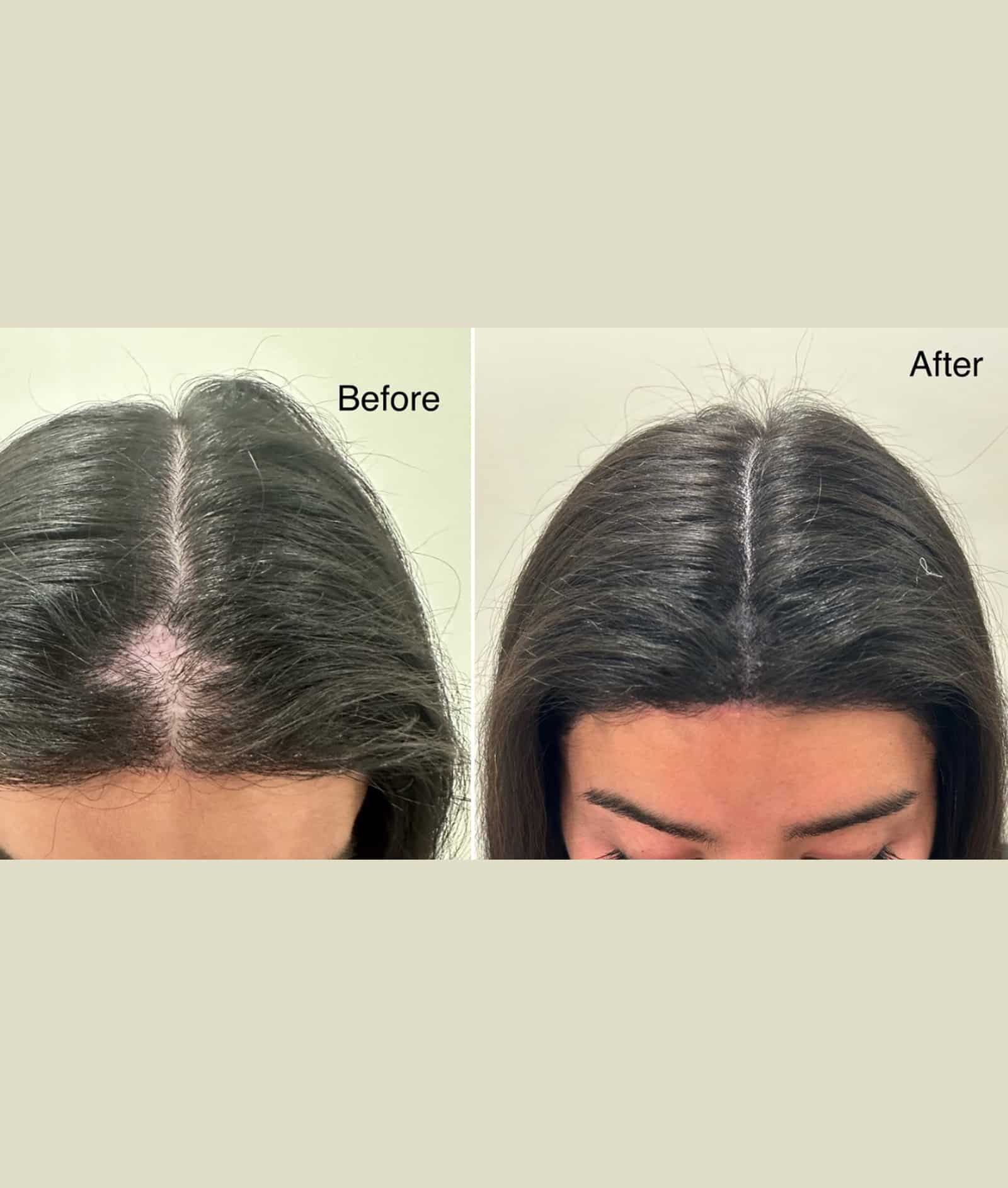 Scalp Micropigmentation