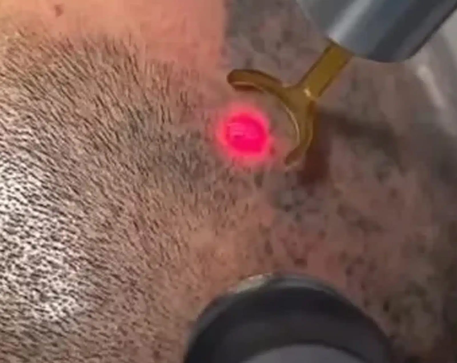 Scalp Pigmentation Removal