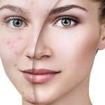 Acne Scar Removal Winter Park