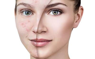 Transform Your Skin: Acne Scar Removal in Winter Park