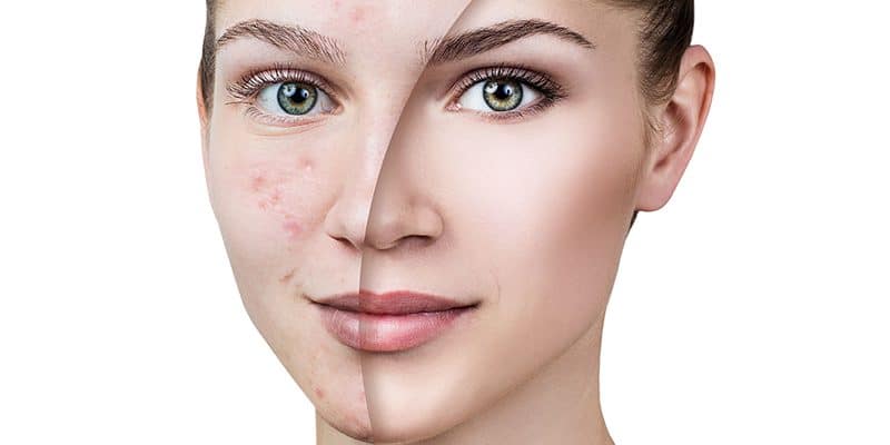 Acne Scar Removal Winter Park