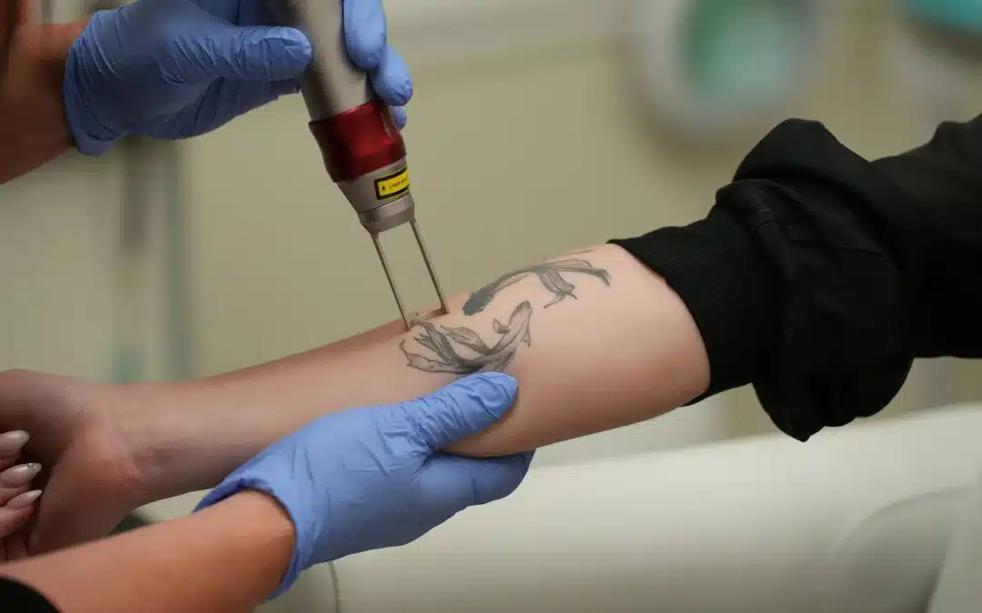 Worried About Tattoo Removal Pain? Lidocaine Can Help