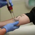 Does Lidocaine Help With Tattoo Removal Pain