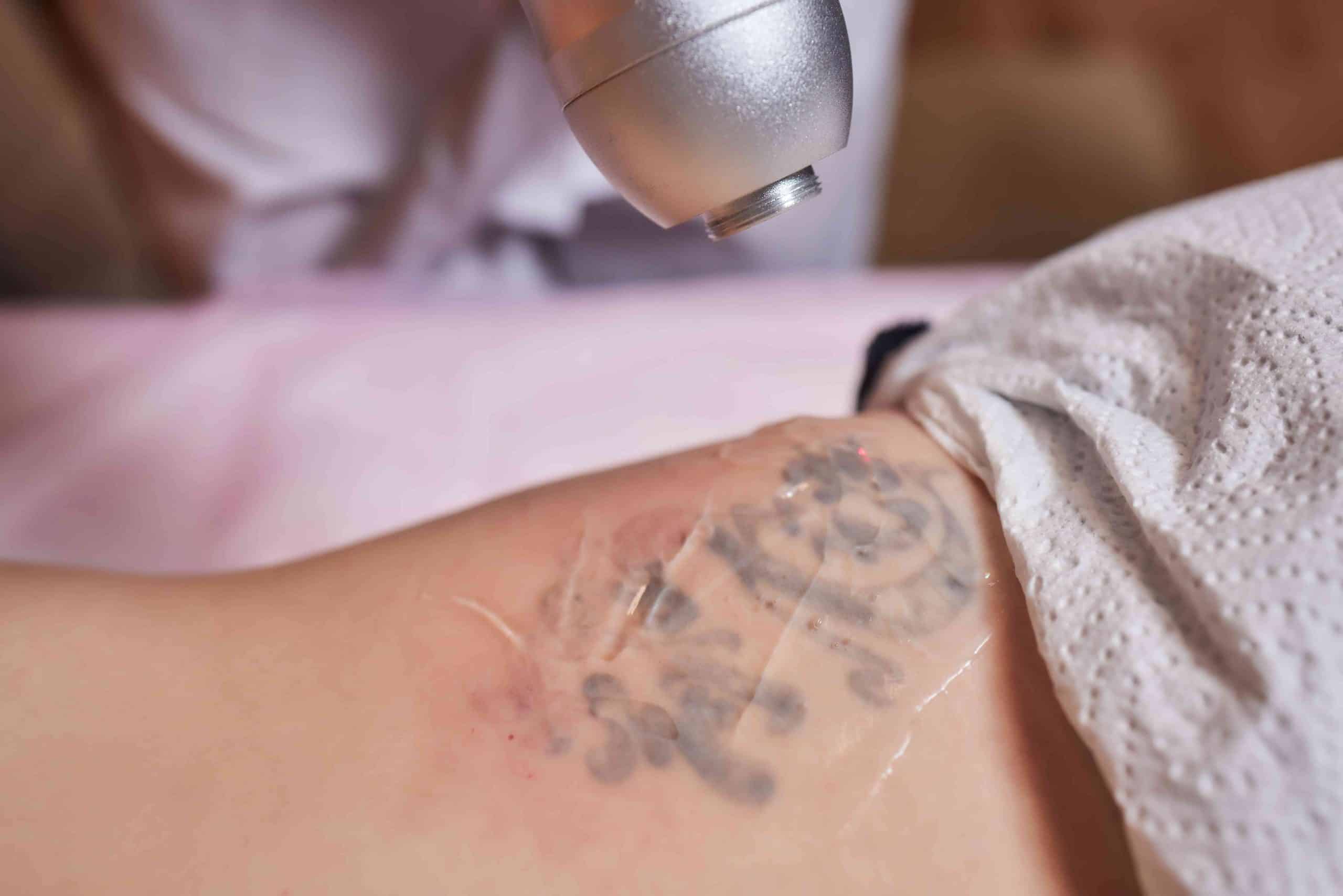Does Lidocaine Help With Tattoo Removal Pain