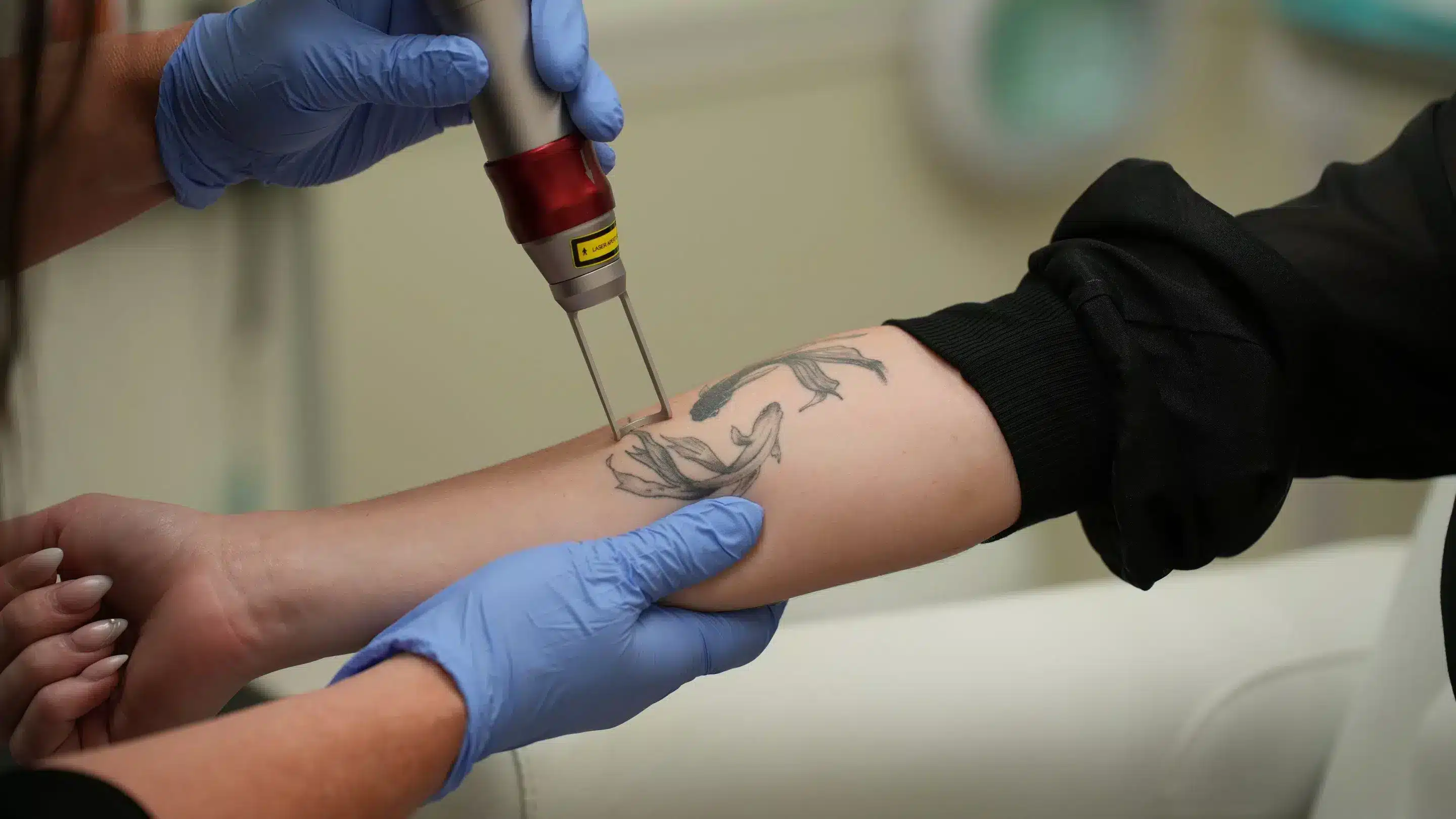 Does Lidocaine Help With Tattoo Removal Pain