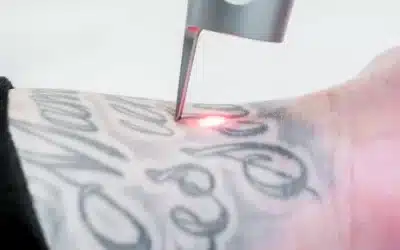 Does Pico Laser Work for Cover-Up Tattoos? A Complete Guide for Winter Park Patients