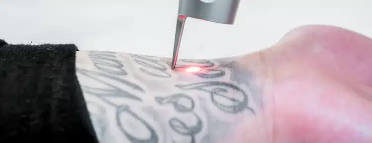 Does Pico Laser Work for Cover-Up Tattoos? A Complete Guide for Winter Park Patients