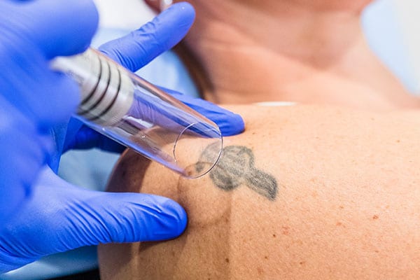 How Lidocaine Injections Work For Tattoo Removal