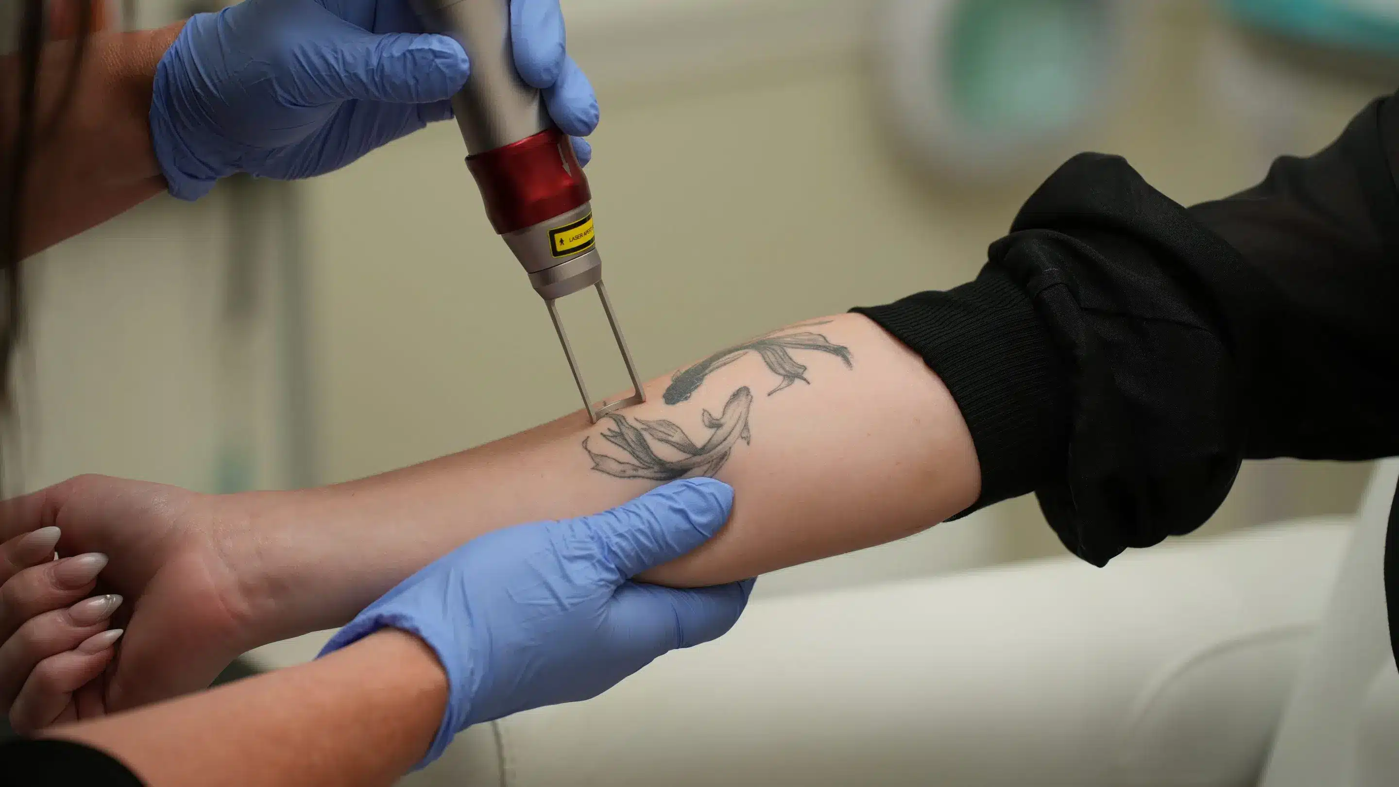 How Lidocaine Injections Work For Tattoo Removal