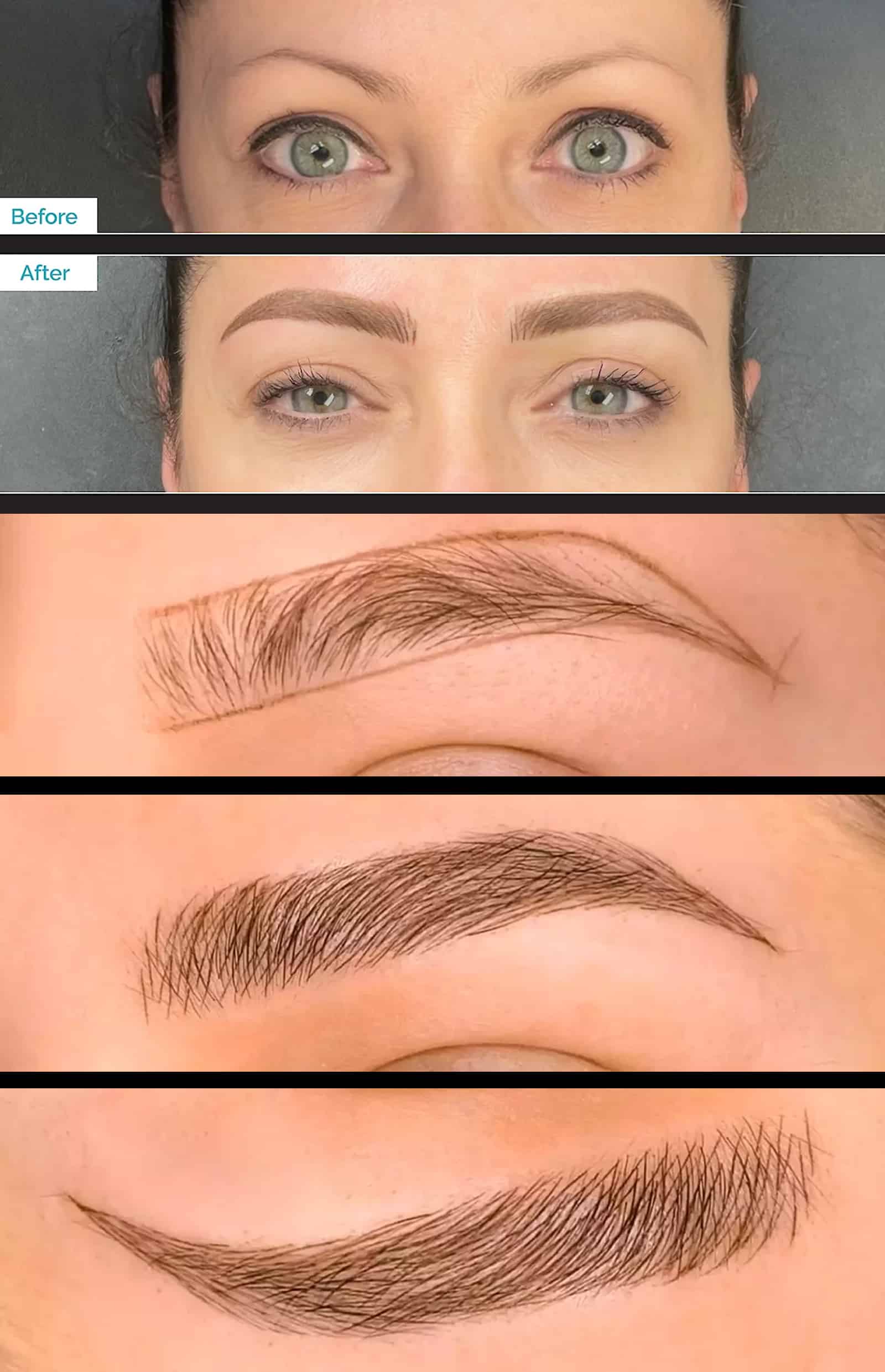 Winter Park Tattoo Removal