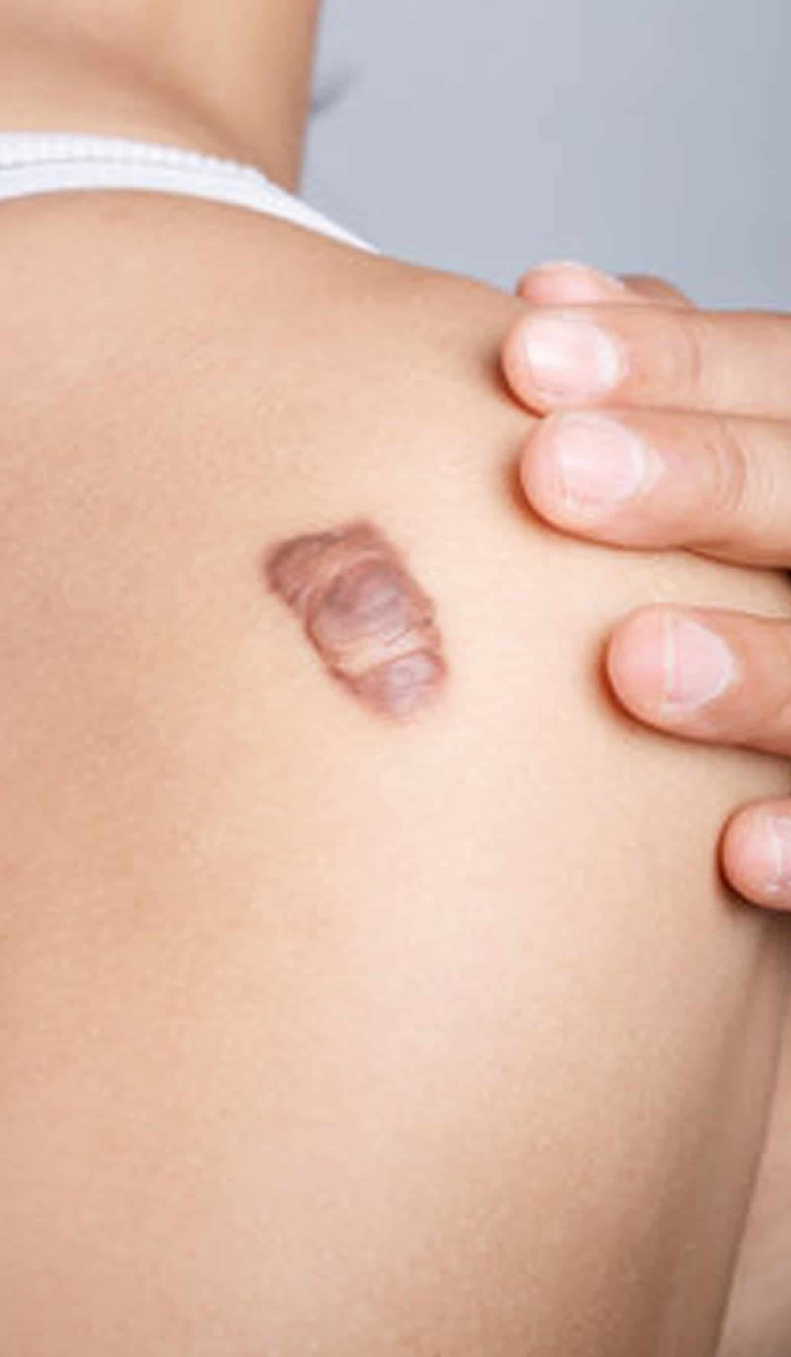 Scars Form and Why They Matter