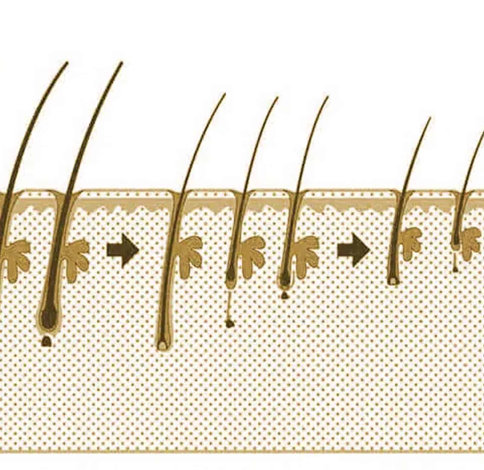 Hair Transplants