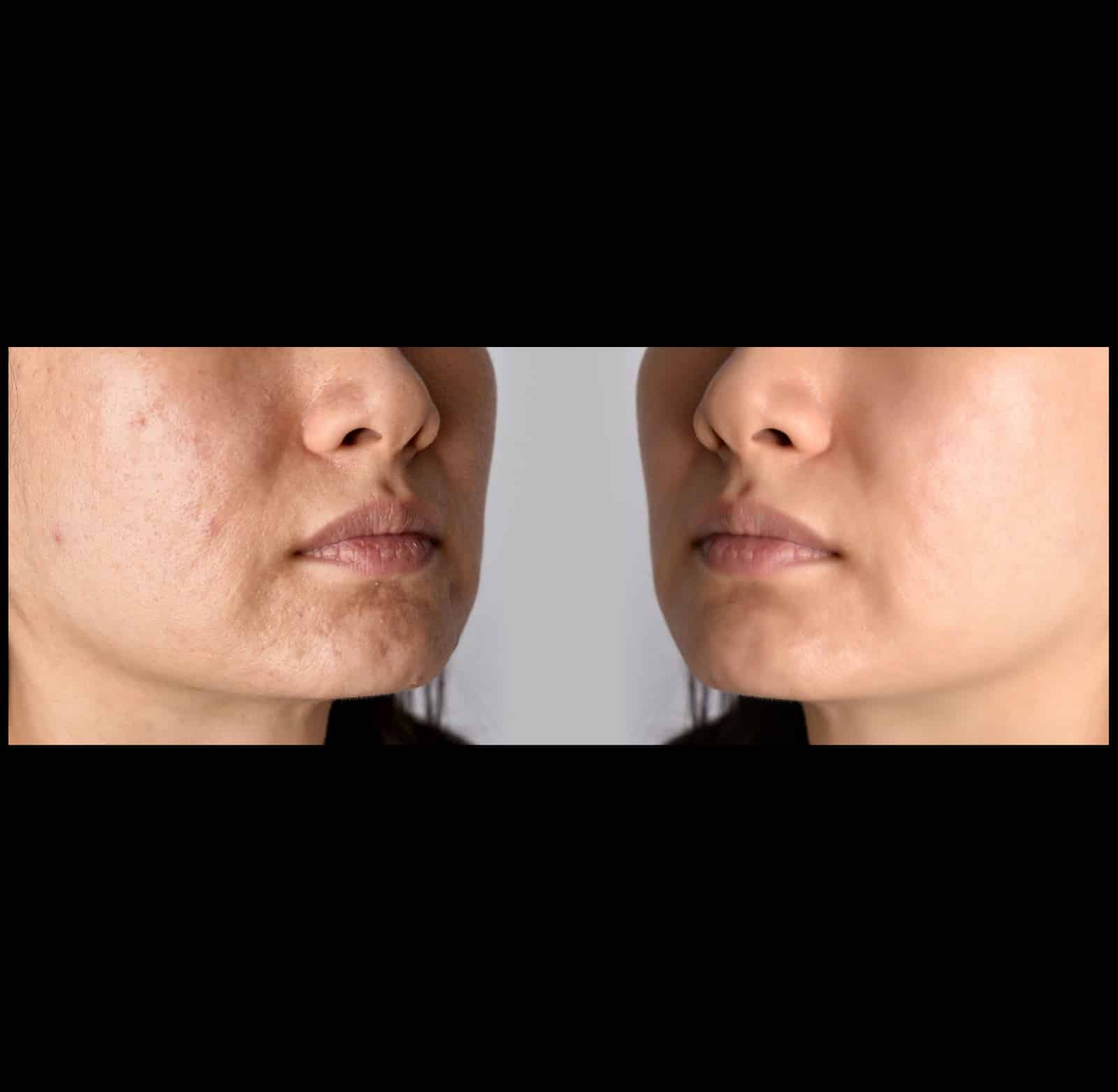 Hypertrophic Scars