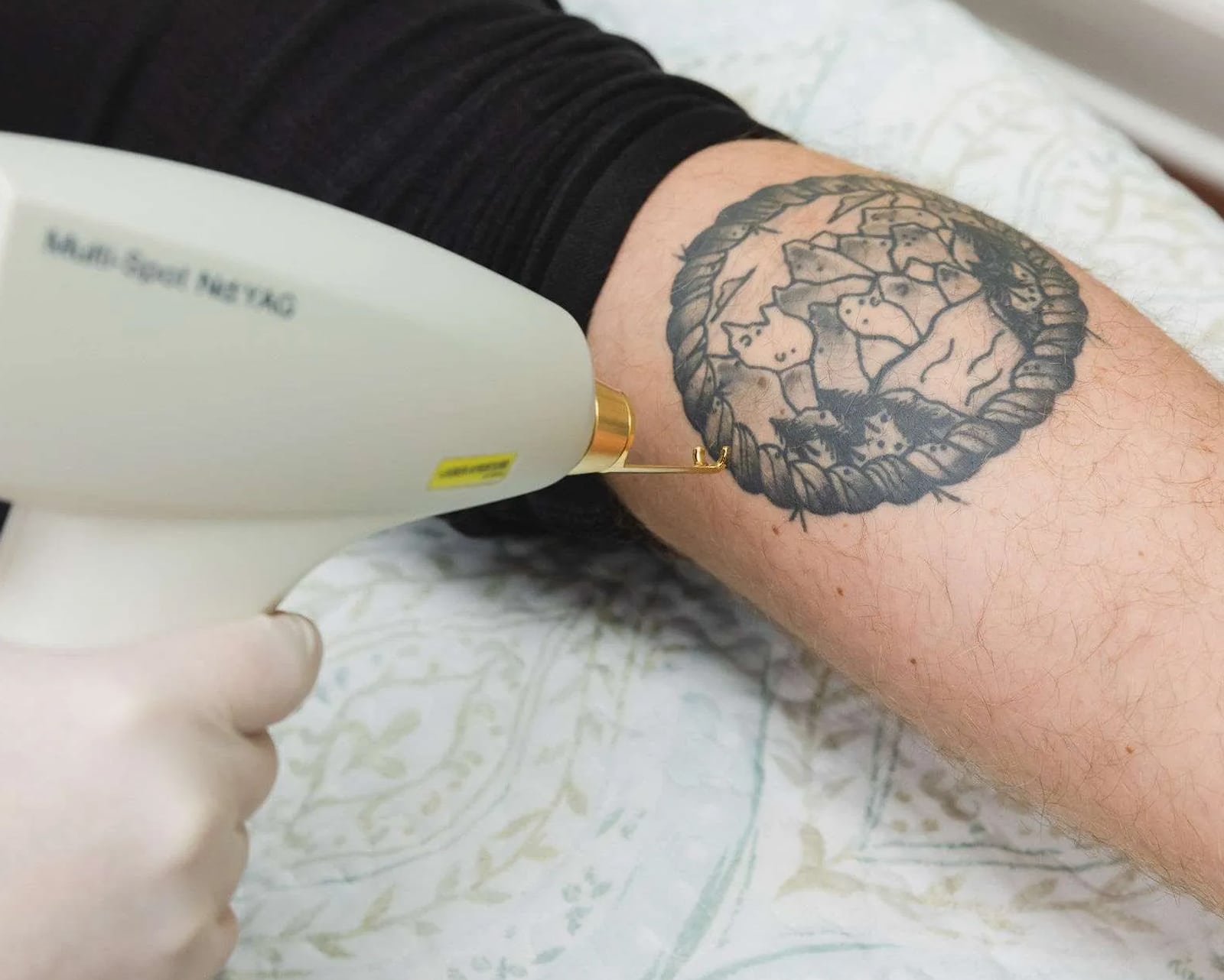 Modern Laser Tattoo Removal Works